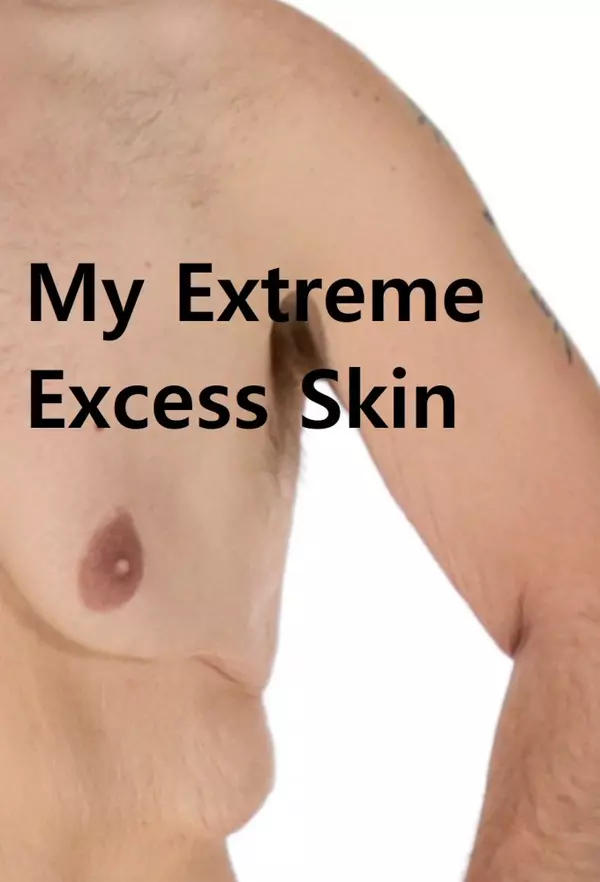 My Extreme Excess Skin